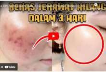 Cara Menghilangkan Jerawat dan Bekasnya