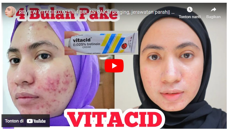 Mengenal Manfaat Krim Penghilang Jerawat Vitacid