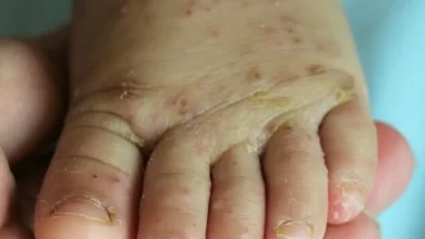 Apa Itu Scabies pada Manusia