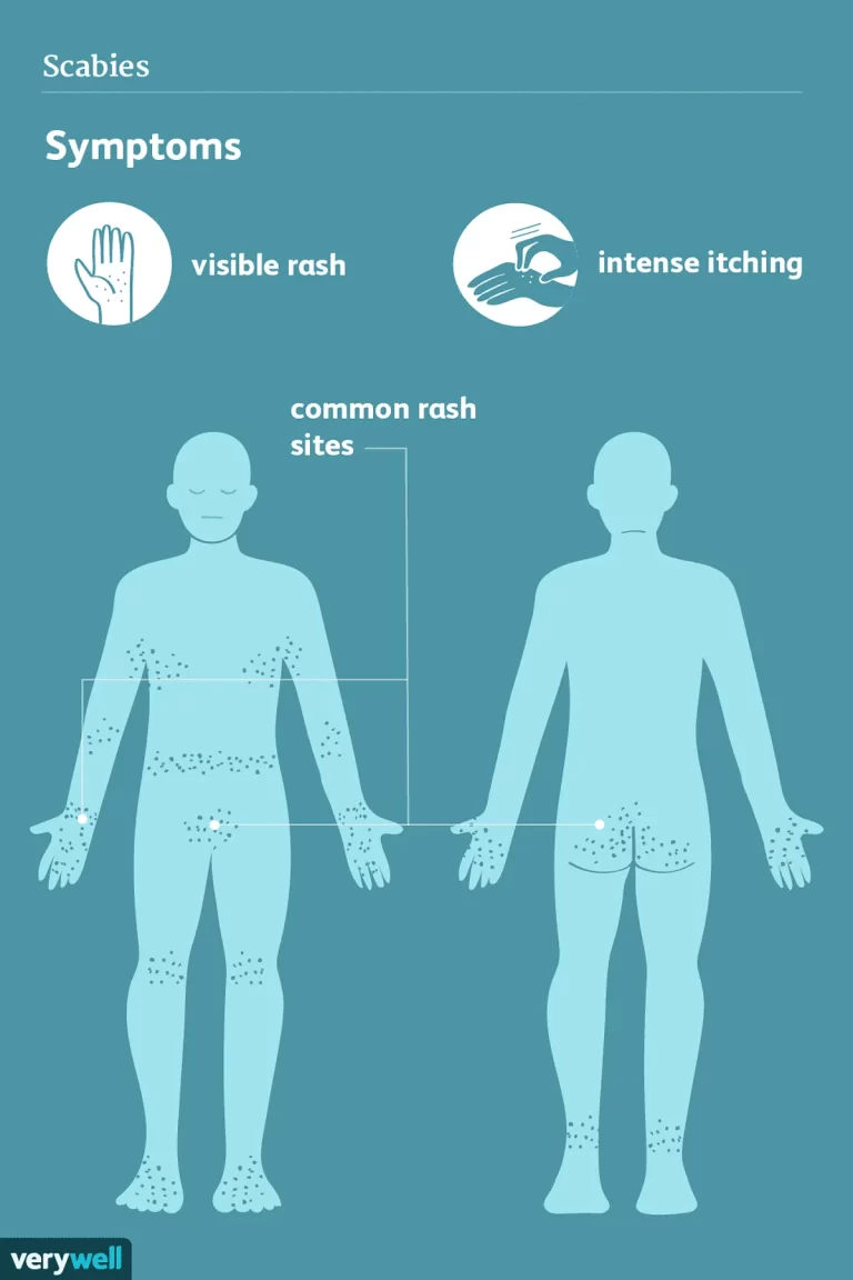 Diagnosis dan Pengobatan Scabies