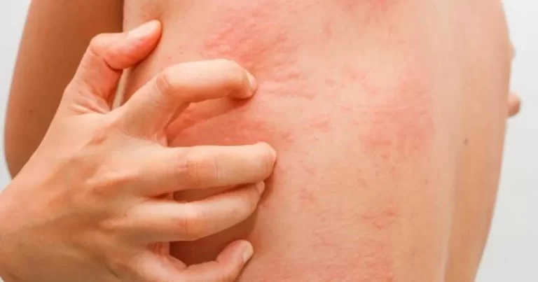 Komplikasi yang Terkait dengan Scabies